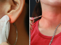 Nguyên nhân bị dị ứng, ngứa khi đeo trang sức bạc